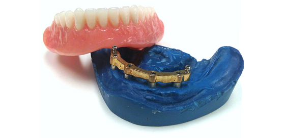 Prothèses sur implants